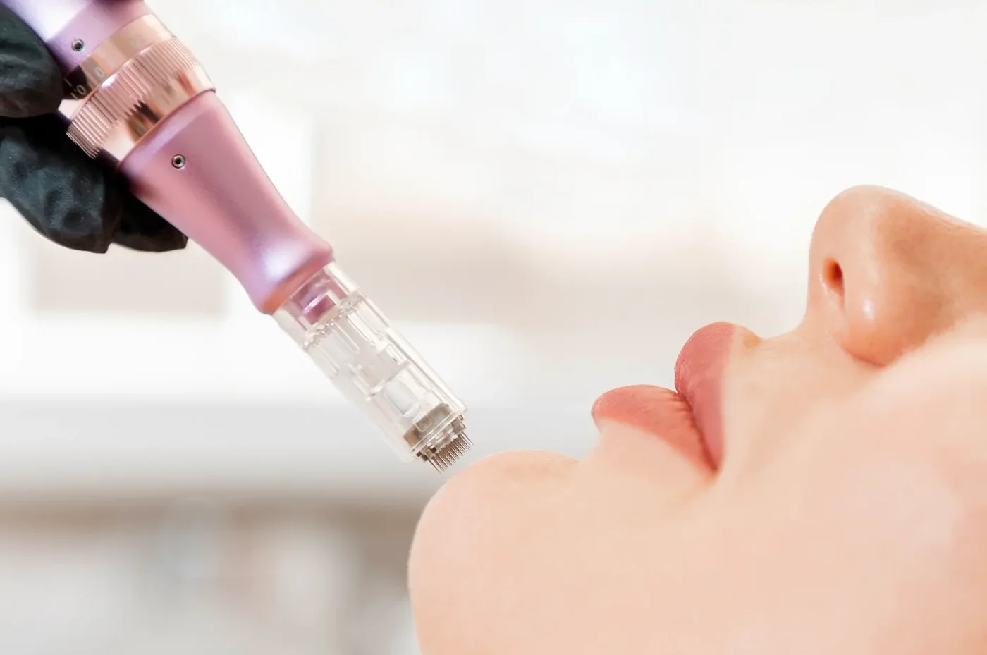 Microneedling mit Radiofrequenz Ludwigsburg – Kosmetikstudio Beate Hornaff