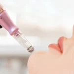 Microneedling